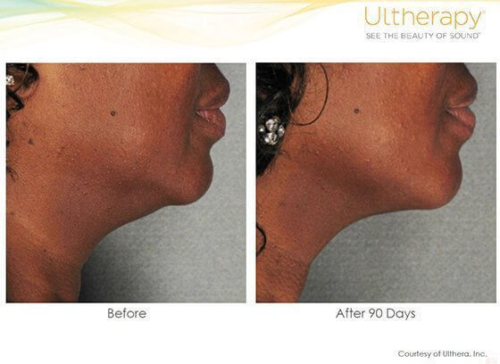 Ulthera Before & After