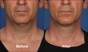 Kybella before and after male