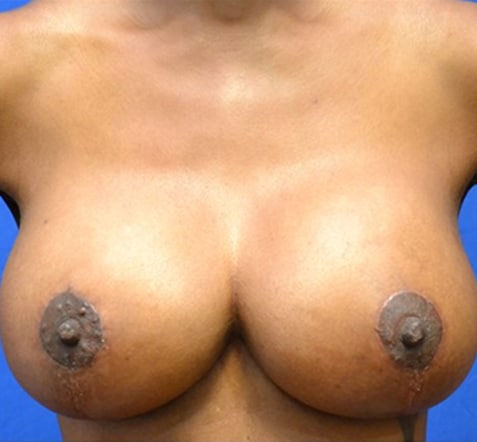 breast augmentation before & after