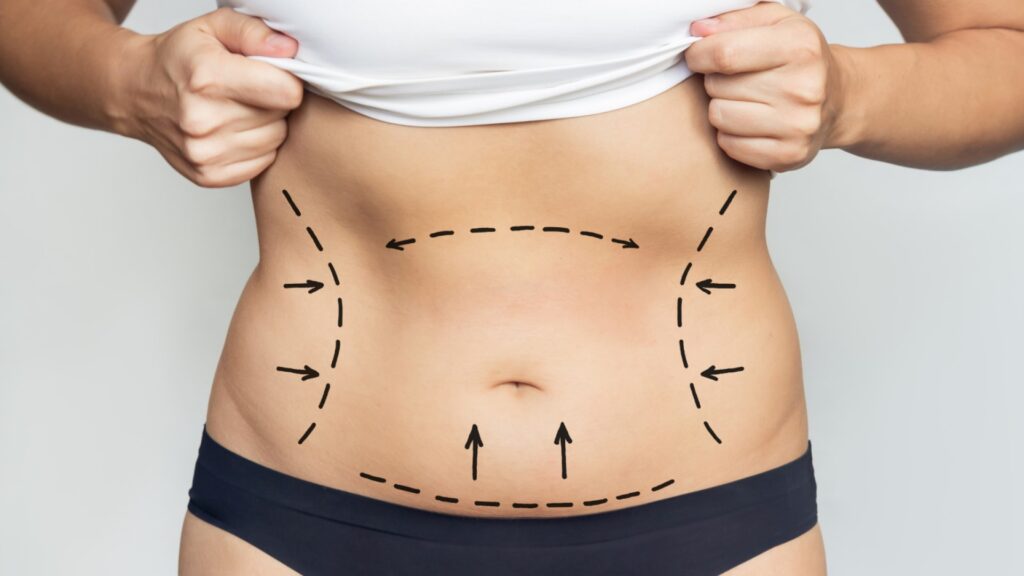 Permanent Fat Removal With Liposuction | Georgia Plastic Surgery