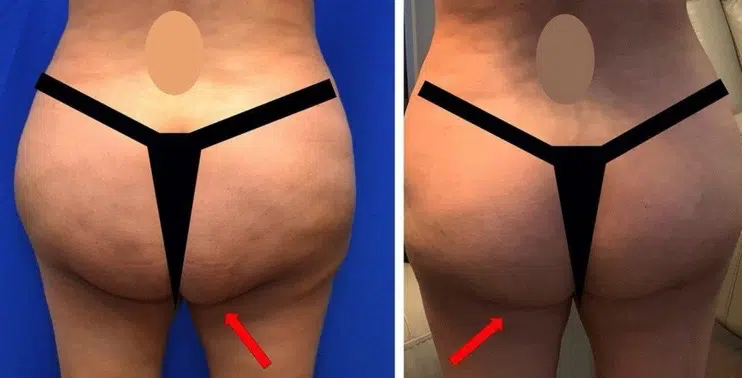 Buttock Contouring - Georgia Plastic Surgery