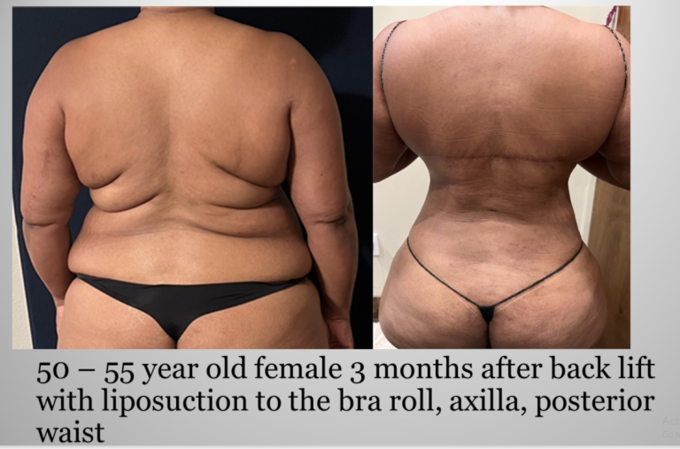 Back Lift with Lipo 360 tuck before and after showing back contour improvement Atlanta Georgia Plastic
