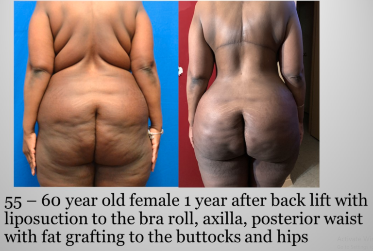 Back Lift with 360 Liposuction bra rolls waistline and BBL Before and After Atlanta Georgia