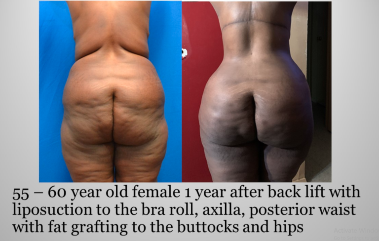 Back Lift with 360 Liposuction bra rolls waistline and BBL Before and After Atlanta Georgia