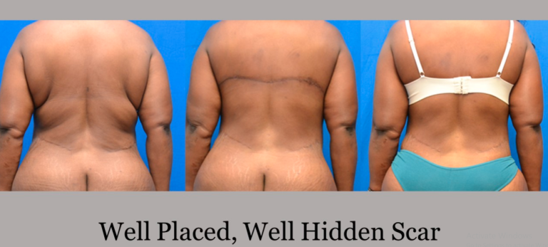 Revision Back Lift with well places scars. Before and after Atlanta Georgia