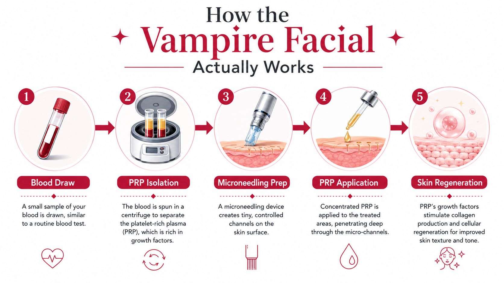 A five-step infographic showing the vampire facial procedure involving blood draw, PRP isolation, microneedling, and skin regeneration.
