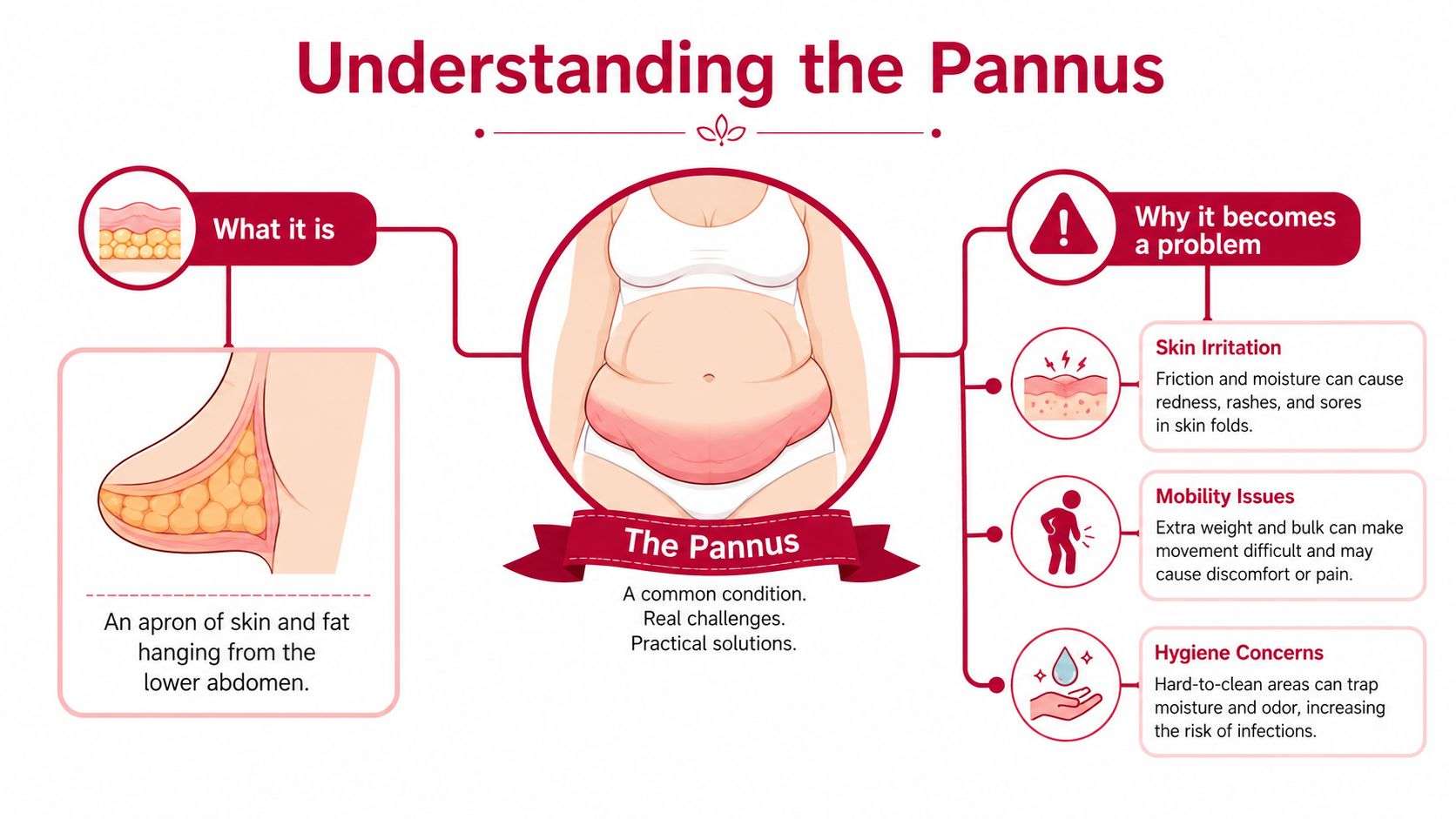 An infographic titled Understanding the Pannus describing it as a skin and fat apron on the abdomen.