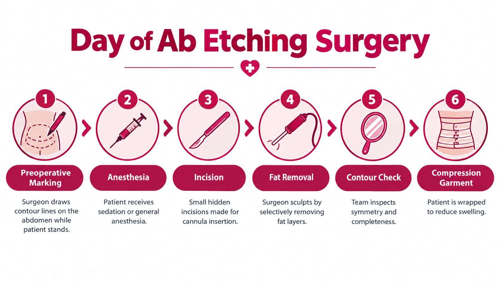 An infographic showing the six steps of the abdominal etching surgery procedure from marking to compression garment.
