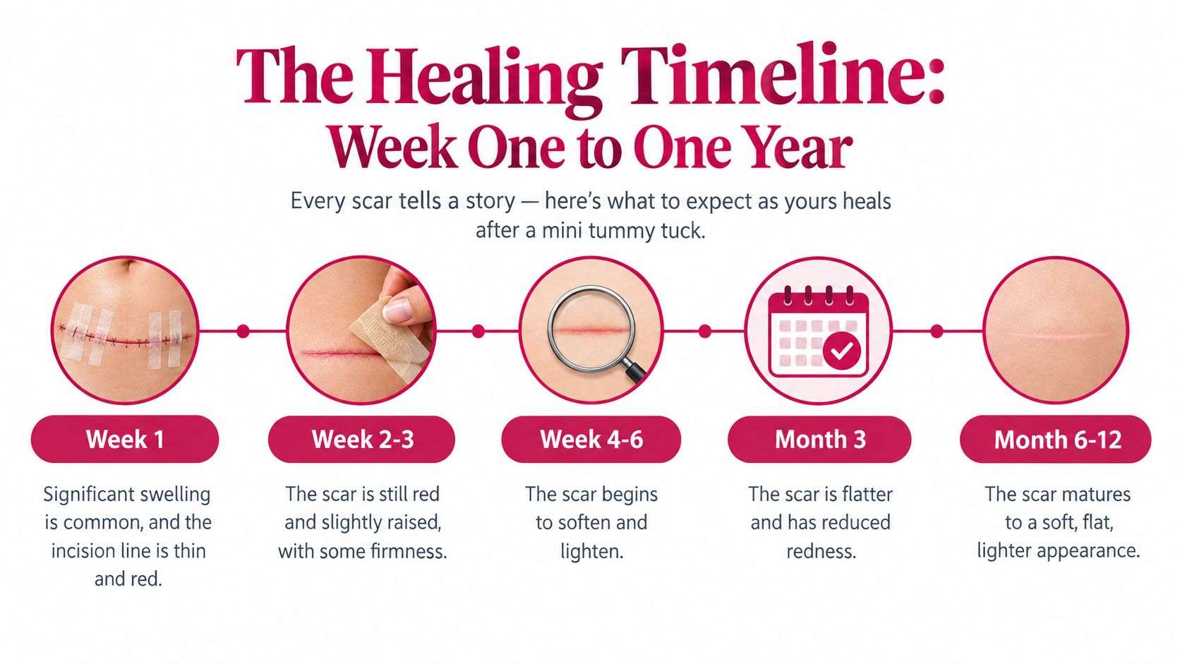 A visual timeline infographic illustrating the healing process of a mini tummy tuck scar from week one to one year.